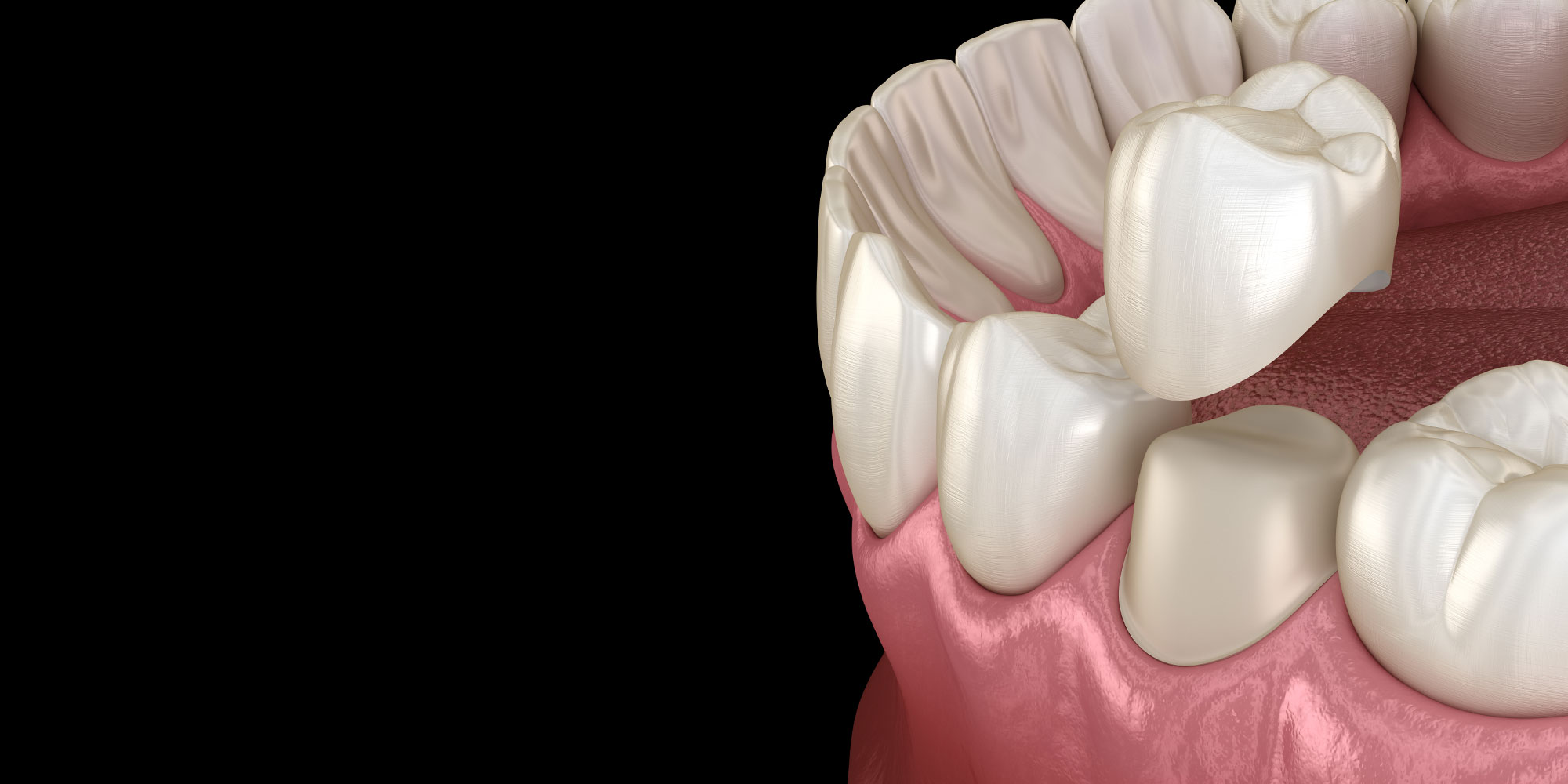 Don’t Know What The Differences Are Between Tooth Crowns And Dental Bridges In Fairfax, VA? We Can Tell You What They Are