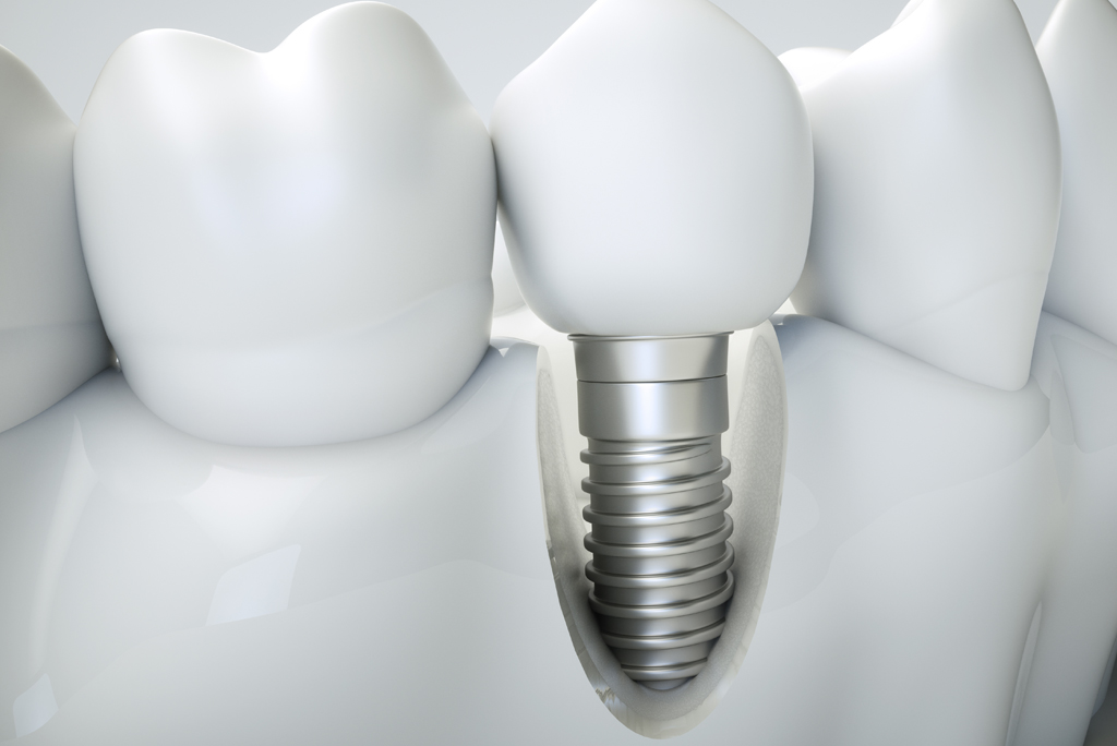 Ready To Learn How Dental Implants In Fairfax, VA, Are Placed? Here Is How.