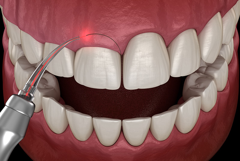 Gingivectomy example model