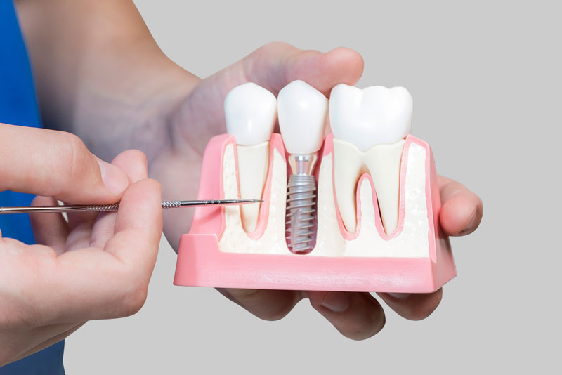 Dental Implant Model Bone Cutaway