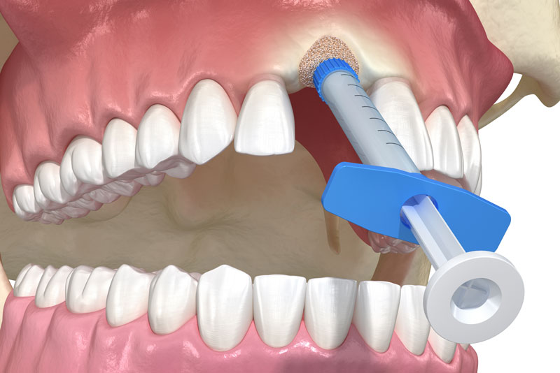 Do I Need Bone Grafting Before A Dental Implant Treatment?