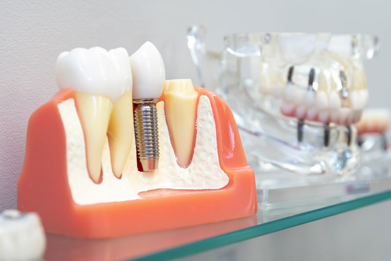 Can I Get Treated With Dental Implants In Woodbridge, VA, After Getting A Tooth Extraction?