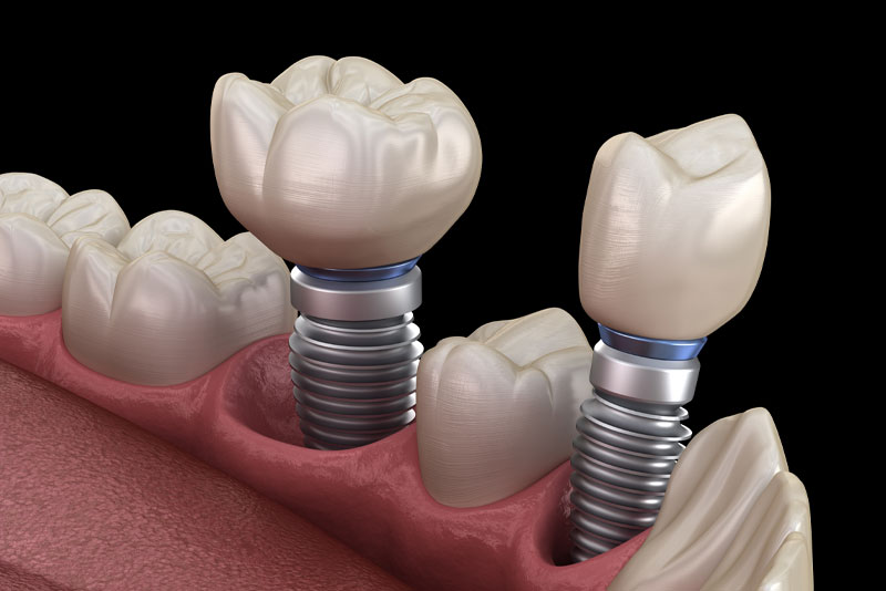 Single Dental Implants Model