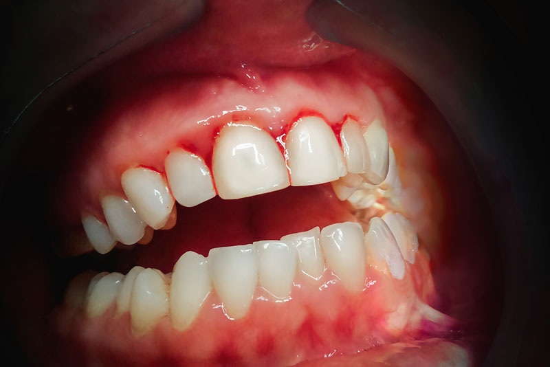 Dental Patient With Bleeding Gums, Suffering From Gum Disease