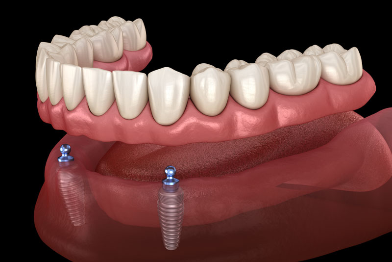 Implant Supported Dentures On 2 Frontal Dental Implants Model