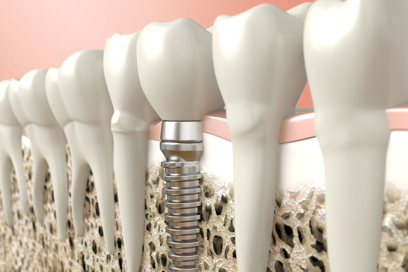 3d rendered image of a dental implant in the jaw bone.