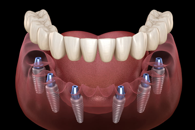 3d model graphic of a full arch on 6 dental implants