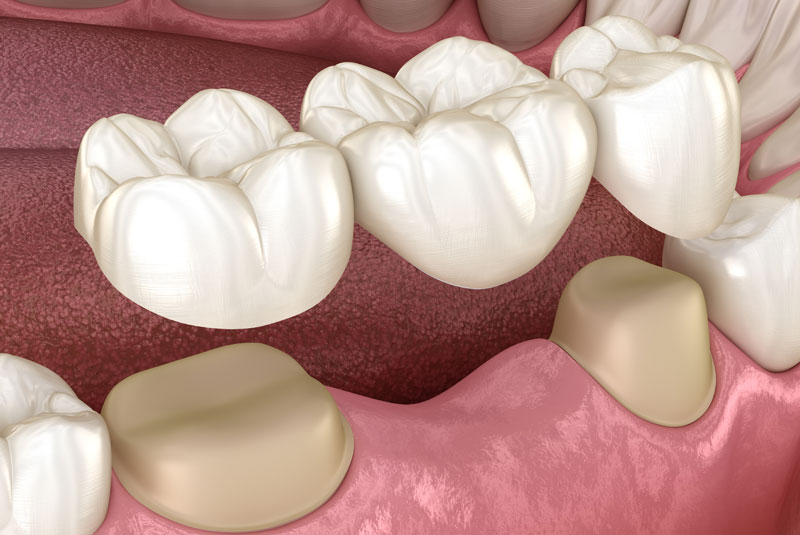 a 3D image of dental crown and bridges in Woodbridge, VA.