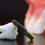 The image shows a dental implant next to a model of a human tooth or jawbone, commonly used in dental offices to demonstrate the function and placement of dental implants.